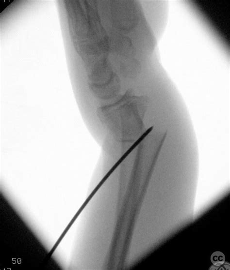 Kapandji Technique Distal Radius Fracture