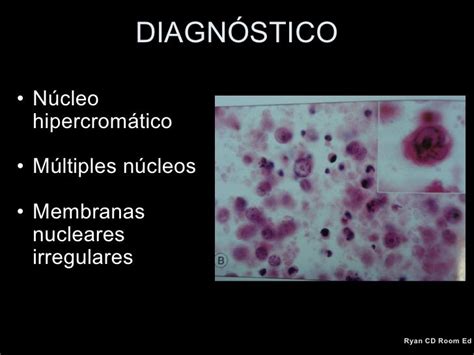 Linfoma Intraocular