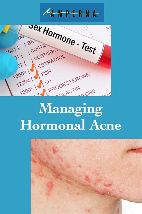 Managing Hormonal Acne Artofit