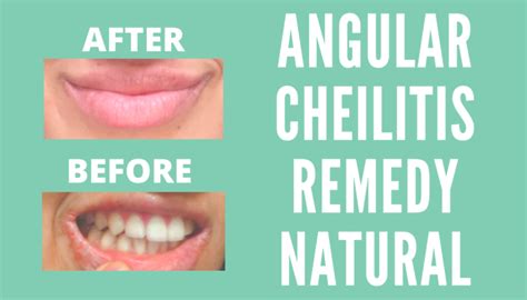 Angular Cheilitis Treatment