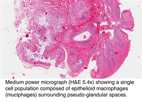 Pathology Outlines Mucocele