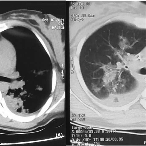 Simple Skull Ct Scan With Periventricular And Capsular Calcifications