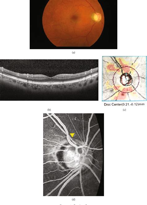 Figure 1 From Retinal Pigment Epithelial Tears After Ex PRESS