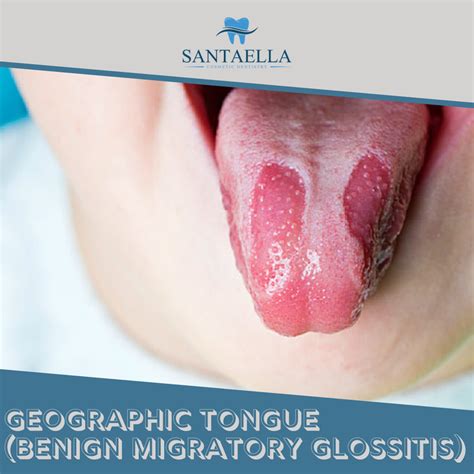 Geographic Tongue Benign Migratory Glossitis