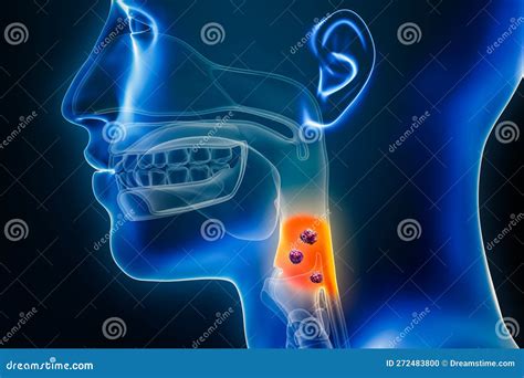 Laryngopharynx Or Throat Cancer With Organs And Tumors Or Cancerous