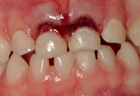 Extrusion Of Primary Central Incisors Requiring Repositioning Of The Teeth Download Scientific