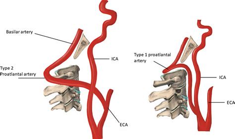 PPA Type 2 Originating From The External Carotid Artery And Extends To