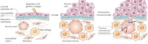 2 Schematic Representation Of Breast Cancer Progression Normal Cells