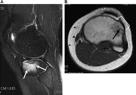 ( A, B ) Fracture of Gerdy’s tubercle. Sagittal ( A ) T2-weighted MR ...