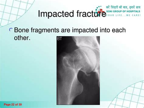 PPT - Fractures and Bone Healing PowerPoint Presentation, free download