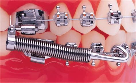 Types Of Appliances Insoft And Hurst Orthodontics