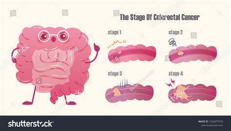 Cartoon Intestine Introduce Stage Colorectal Cancer Stock Vector ...