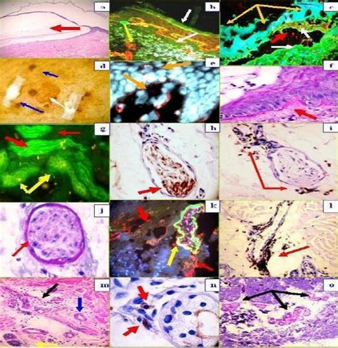 H And E Staining 100x Demonstrating The Subepidermal Blister Red Download Scientific Diagram