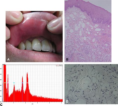 Crohns Disease And Cheilitis Granulomatosa Role Of Silicone Fillers