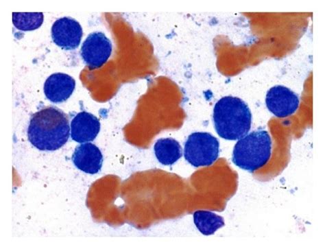 A First Bone Marrow Biopsy Showing Hypercellular Marrow Packed With