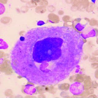 PDF Megakaryocytic Alterations In Bone Marrow Aspiration Smears In