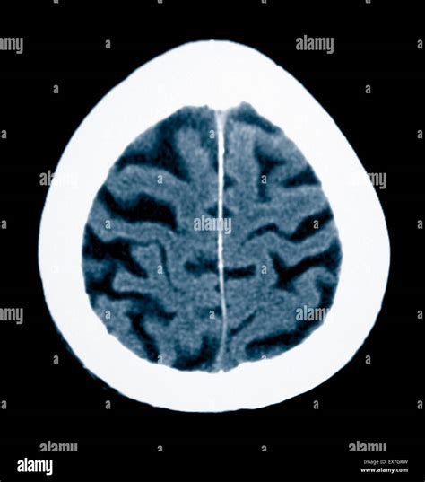 Ct Scan Of An 84 Year Old Man With Alzheimers Disease Ct Shows Brain