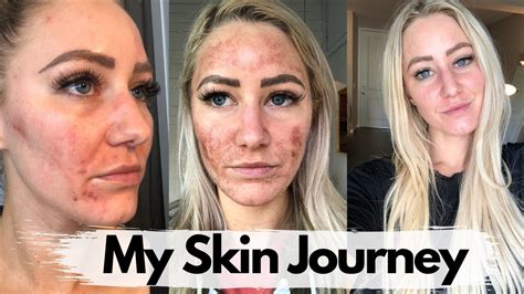 The Best Skincare And Makeup For Sensitive Acne Prone Skin My Skin Journey Youtube