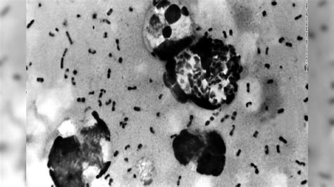 Everything To Know About Bubonic Plague As It Spreads Again News18