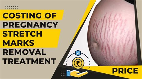 How Much Does It Cost To Remove A Stretch Mark After Pregnancy Stretch Mark Removal After