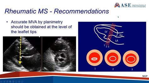 Ase Guideline Recommendations For The Use Of Echo In The Evaluation Of Rheumatic Heart Disease