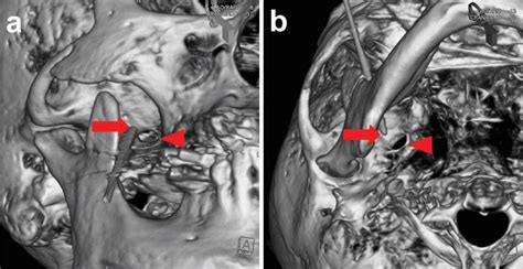 Figure 3 From Percutaneous Glycerol Rhizotomy For Trigeminal Neuralgia