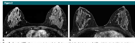 Figure 2 From Are Qualitative Assessments Of Background Parenchymal