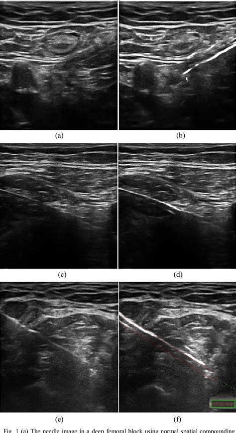 Figure 1 From In Vivo Needle Visualization In Ultrasound Images Using