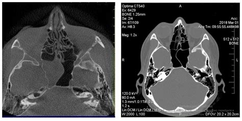 Diagnostics Free Full Text Isolated Sphenoid Sinusitis Anatomical Features For Choosing A