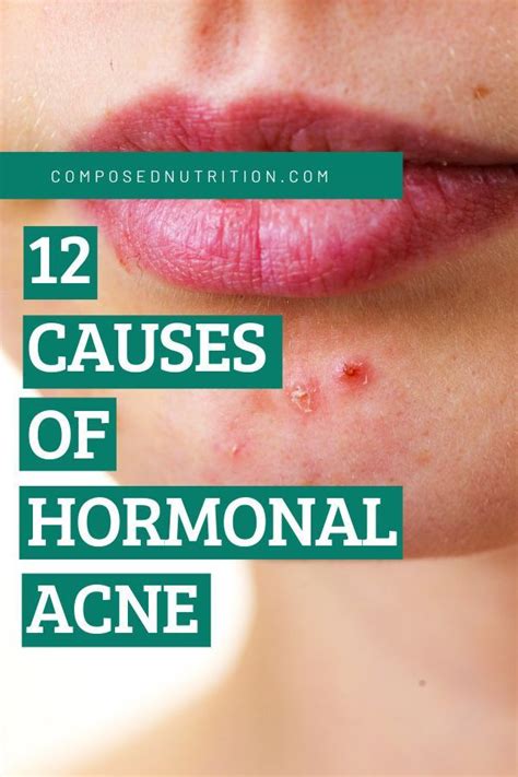 Understanding The Causes Of Hormonal Acne