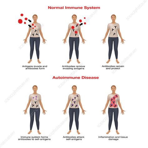 Autoimmune Disease Illustration Stock Image F031 7417 Science