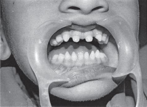 Anodontia Of Permanent Teeth A Case Report Semantic Scholar