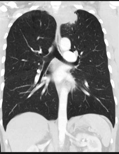 Solid Pleural Lesions Ajr