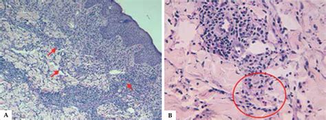 SciELO Brasil - Eosinophilic annular erythema in adults: report of two ...