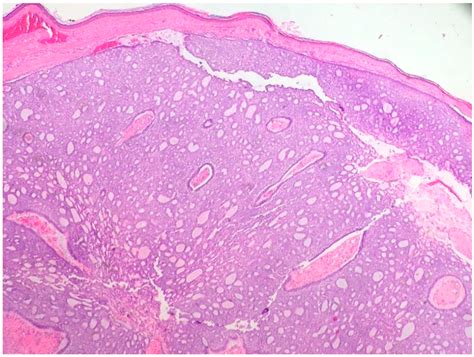 Merkel Cell Carcinoma Histology : Cytokeratin 20 Negative Merkel Cell ...