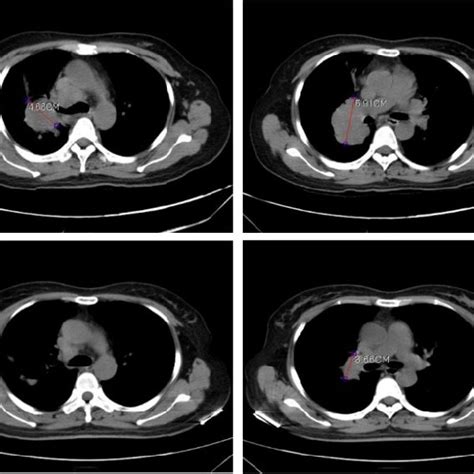 Computerized Tomography Ct Scans Showing Tumor Regression In The