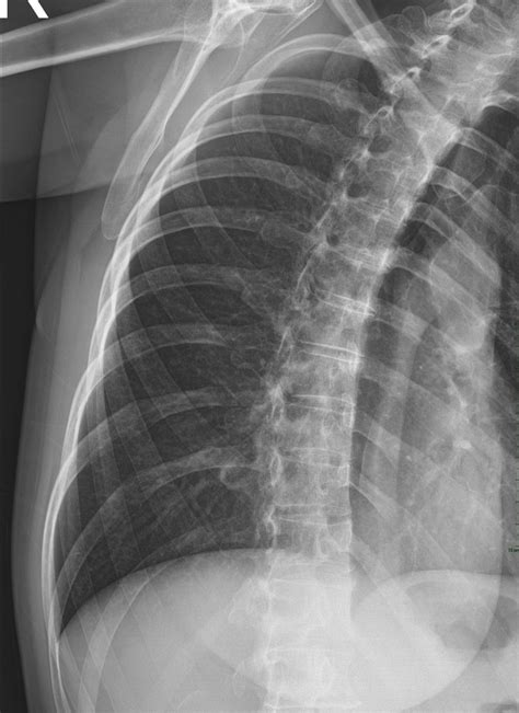 Hidden Fracture Of Lower Angle Of Scapula Image Radiopaedia Org