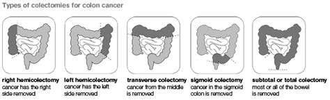 Laparoscopic Surgery For Cancer Of Large Intestine Right Hemicolectomy