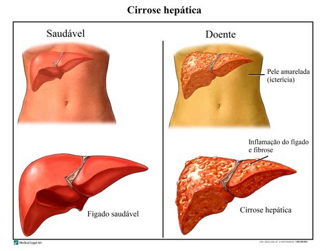 CIRROSE HEPÁTICA Raquel Luiza