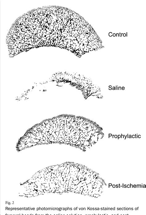 Femoral Head Deformity | Semantic Scholar