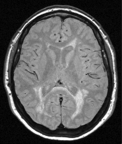 Mr Imaging Of Multiple Sclerosis Radiology