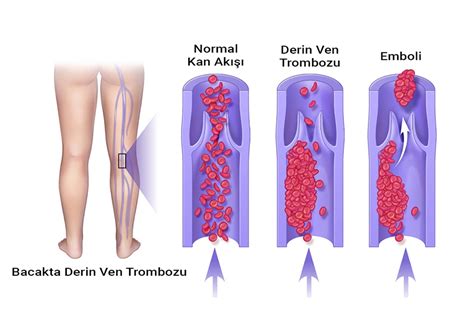 Derin Ven Trombozu Belirtileri Ngiliz Tuzu Ve Sa L K