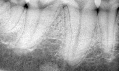 How to Interpret Dental Radiographs | Clinician's Brief