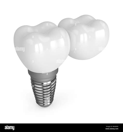 Cantilever Dental Implant At Thomas Gabaldon Blog