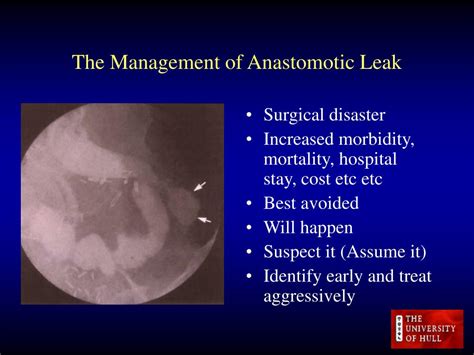 PPT The Management Of Anastomotic Leak PowerPoint Presentation Free