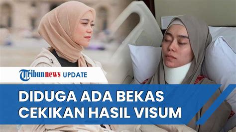 Polisi Ungkap Hasil Visum Lesti Kejora Seusai Kdrt Titik Luka Memar