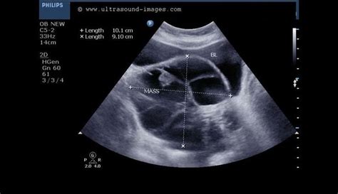 Macrocystic Cystadenoma Ovarian Ultrasound Mass