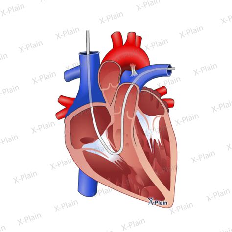 Right Heart Catheterization