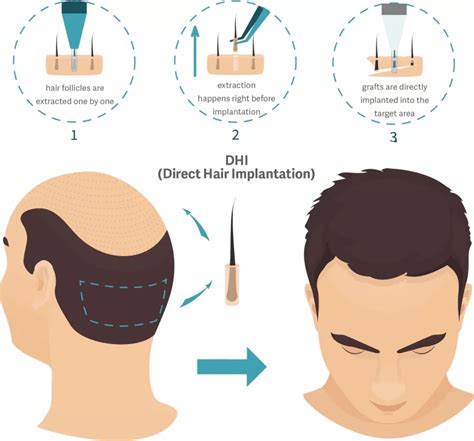 DHI Method Hair Transplant Medousa Clinique