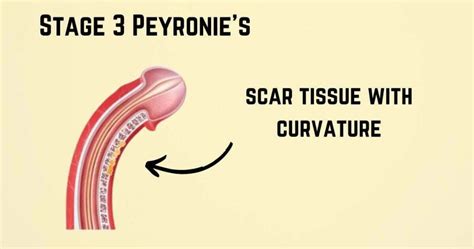 Pictures Of Peyronie S Disease Real Pictures